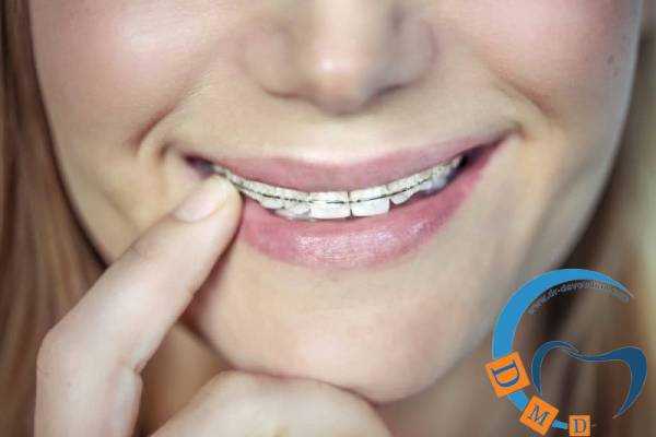 کندن و چسپاندن و کندن براکت ارتودنسی
