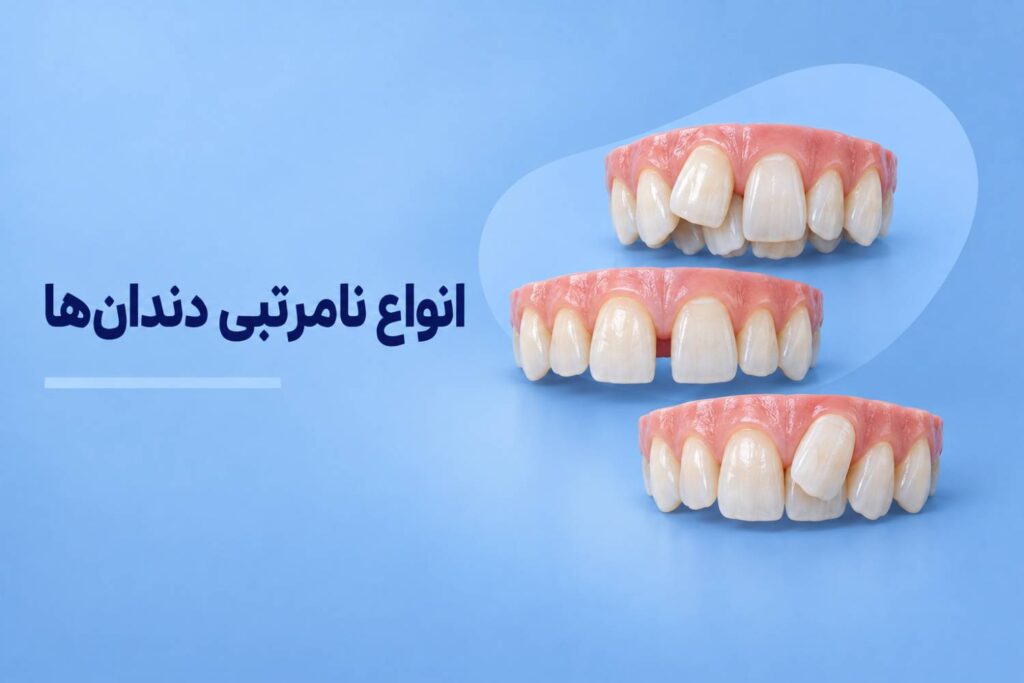 انواع نامرتبی دندان ها