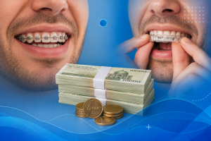 هزینه بیشتر ارتودنسی فلزی نسبت به ارتودنسی فلزی