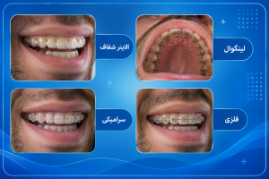 مقایسه انواع روش های ارتودنسی نامرئی