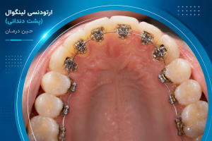 ارتودنسی لینگوال 