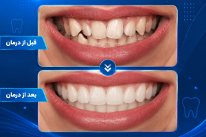 ارتودنسی نامرئی چیست؟