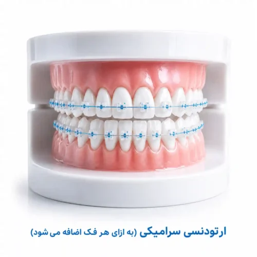 قیمت ارتودنسی سرامیکی چهار دندان جلو