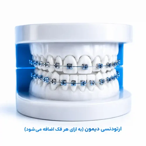 قیمت ارتودنسی دیمون چهار دندان جلو