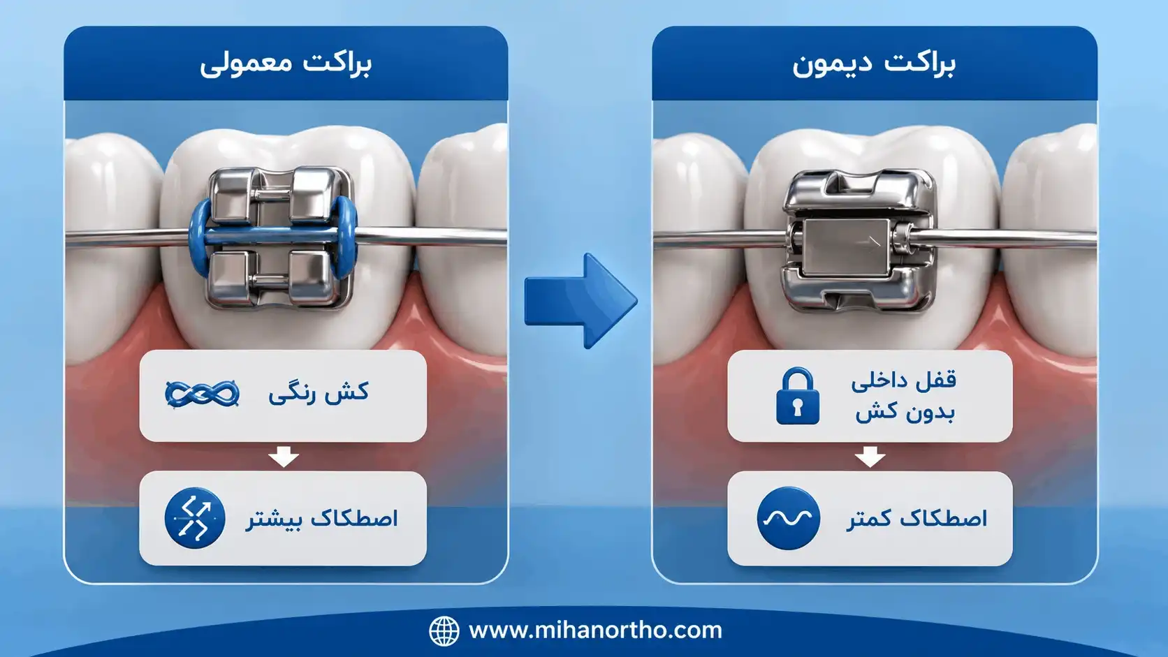 ارتودنسی دیمون چیست؟