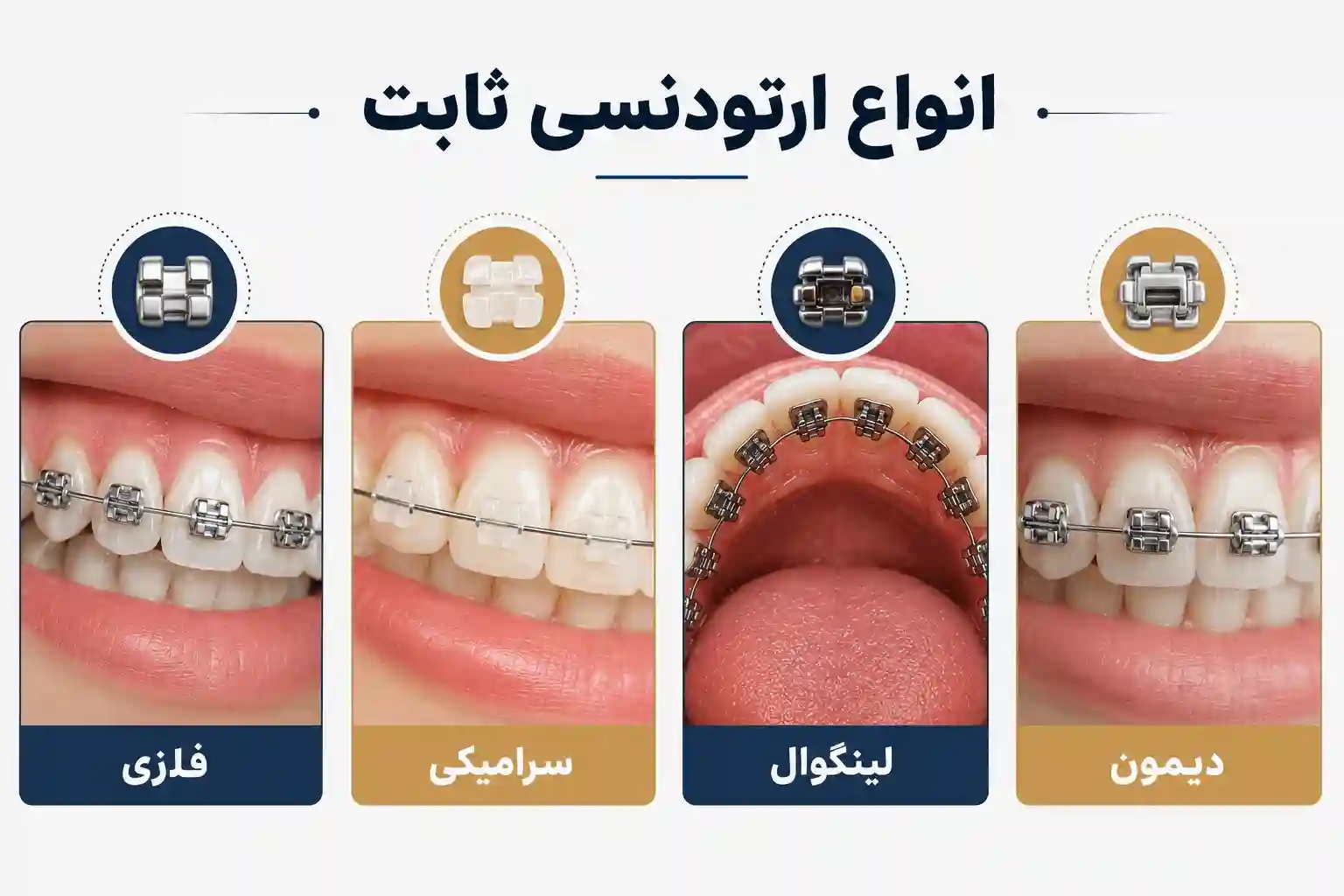 انواع ارتودنسی ثابت