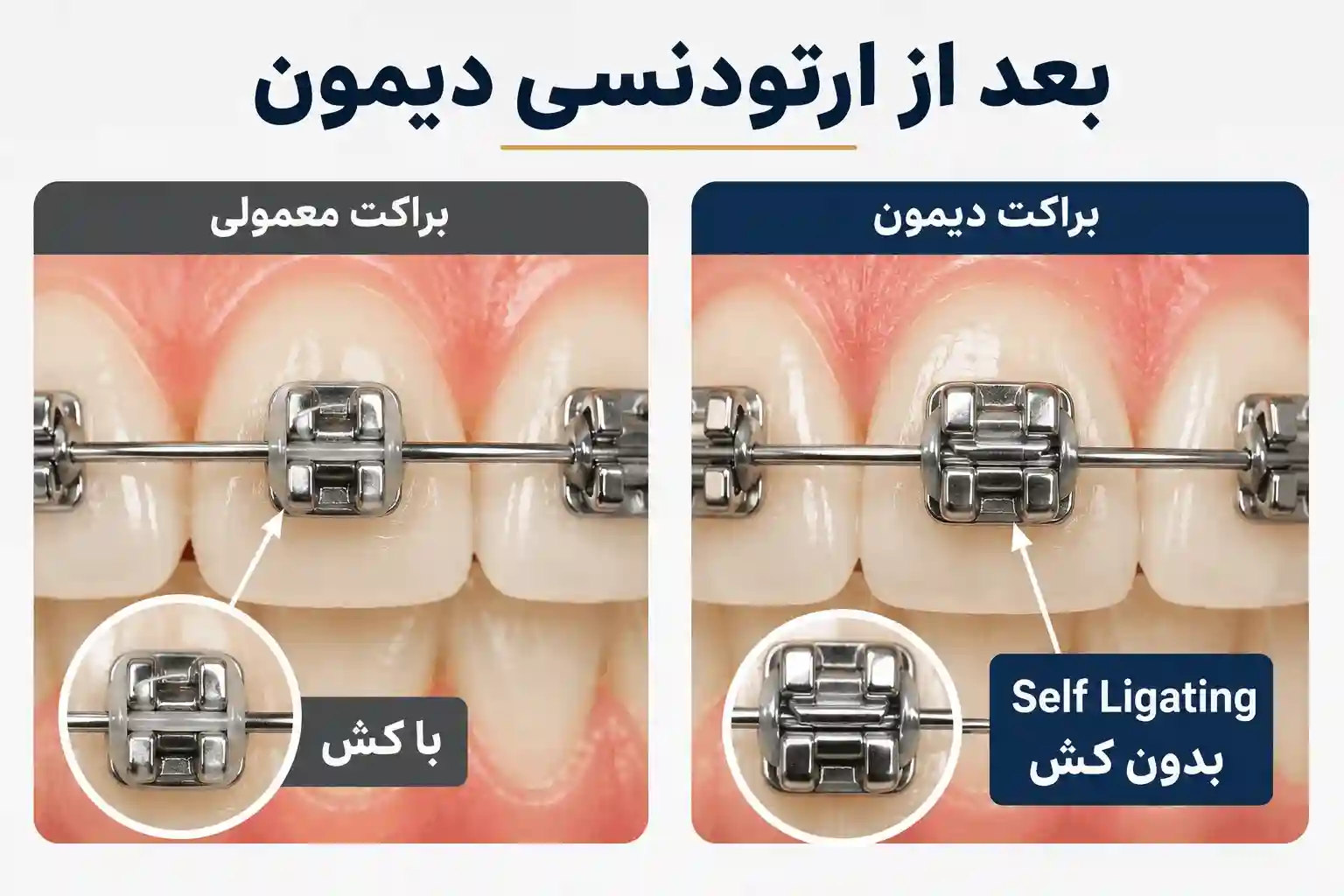 قبل و بعد ارتودنسی لینگوال یکی از انواع ارتودنسی ثابت