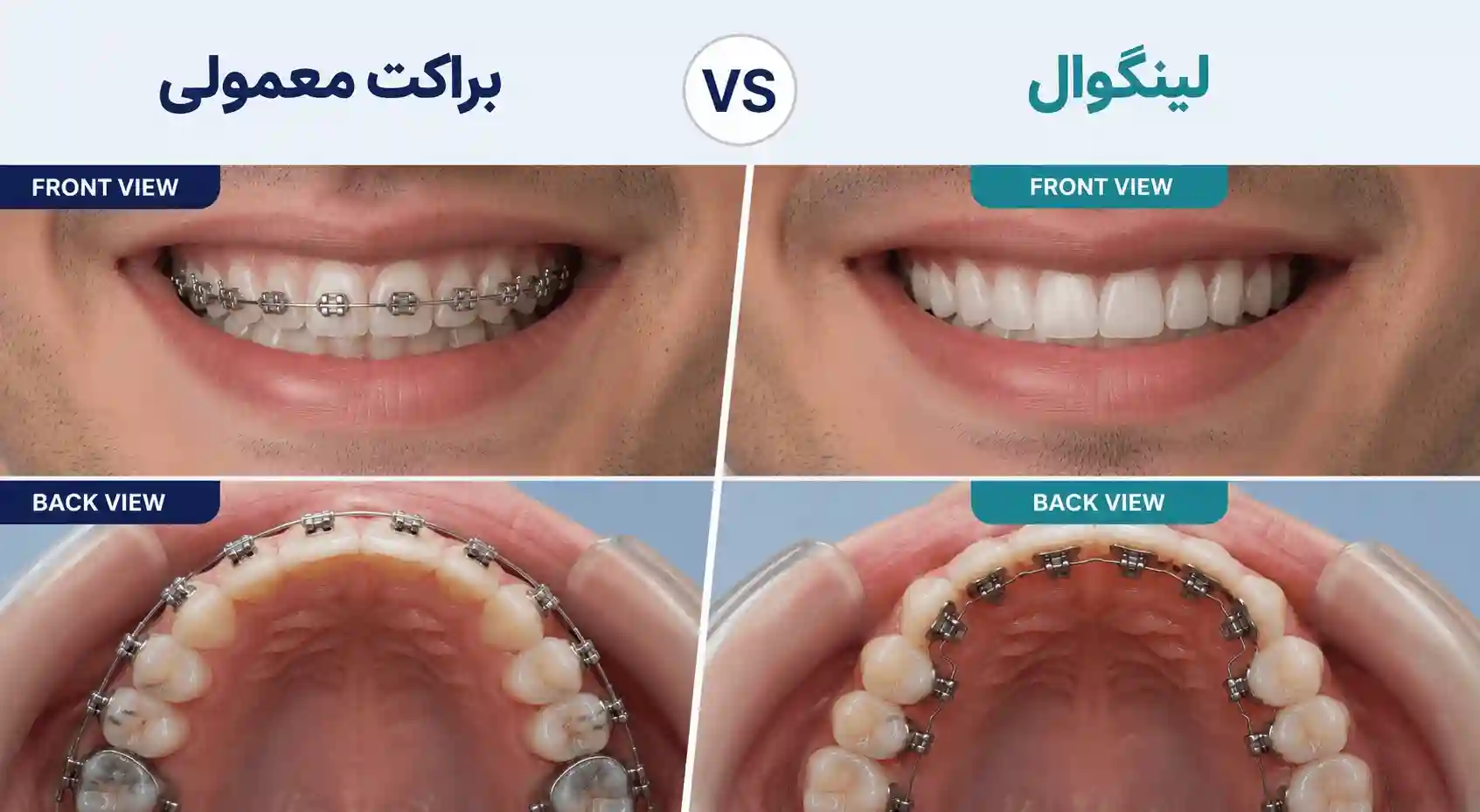 بعد از ارتودنسی لینگوال