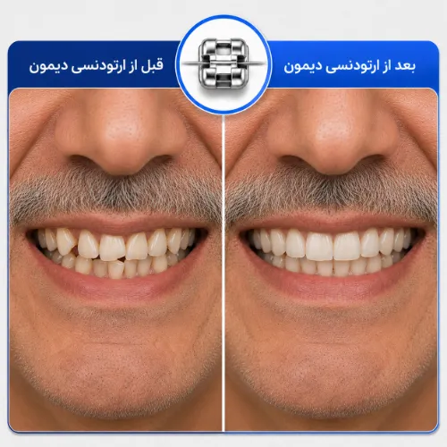 نمونه کار ارتودنسی دیمون