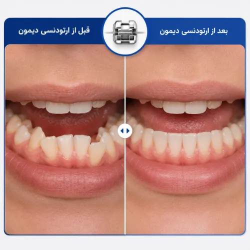 نمونه کار ارتودنسی دیمون