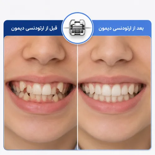 نمونه کار ارتودنسی دیمون