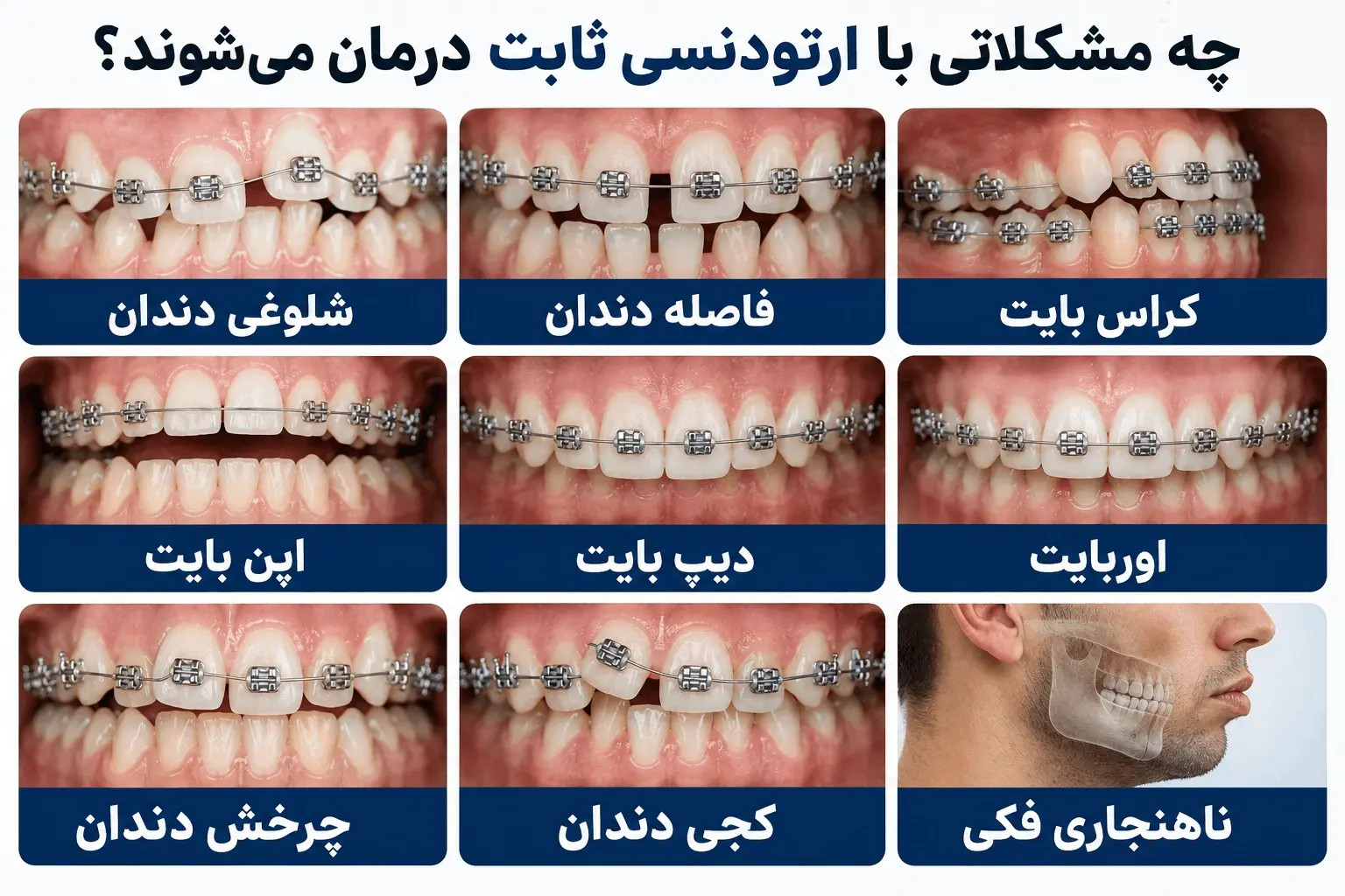 چه مشکلاتی با ارتودنسی ثابت رفع می شود