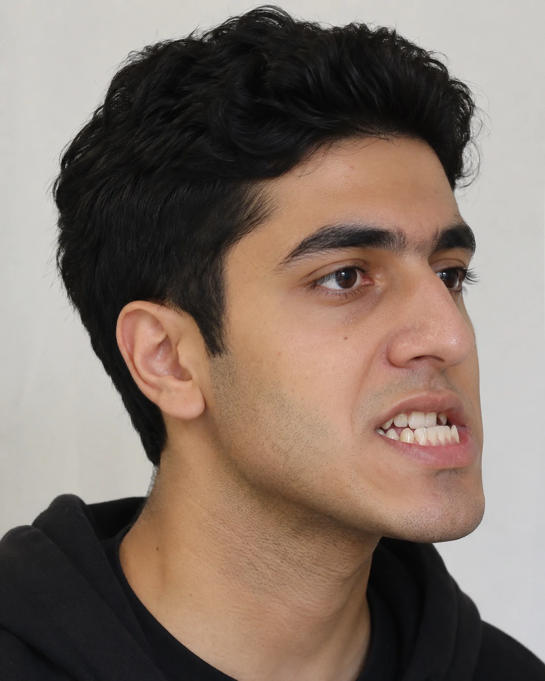 قبل از درمان ارتودنسی و جراحی فک
