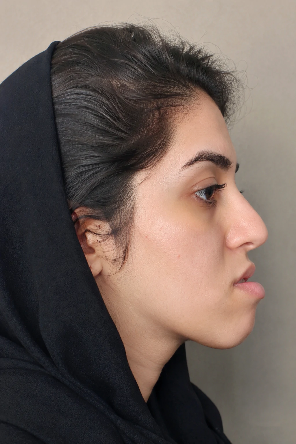 قبل از اصلاح ناهنجاری فکی