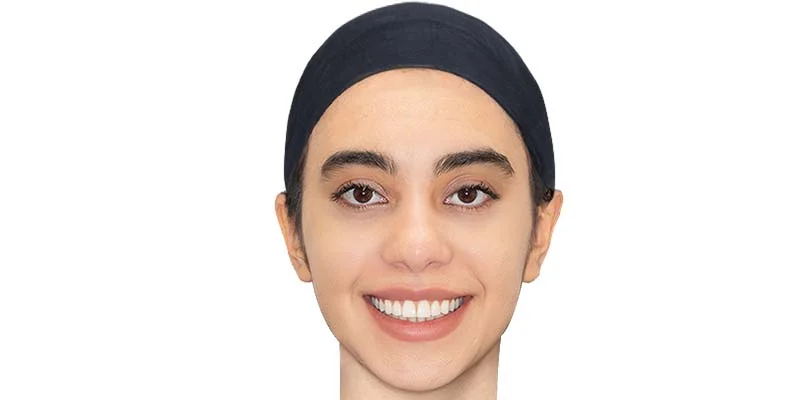 نمای روبهروی صورت بعد از درمان ارتودنسی، کیس دوم