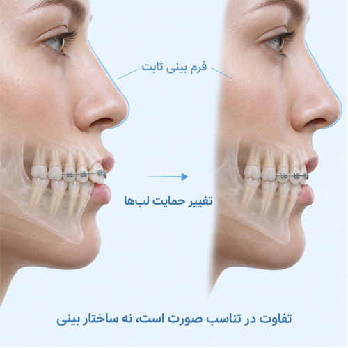 آیا ارتودنسی می‌تواند فرم بینی جراحی‌شده را تغییر دهد؟