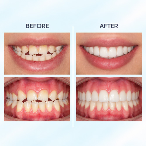 آیا اصلاً مقایسه ارتودنسی و لمینت درست است؟