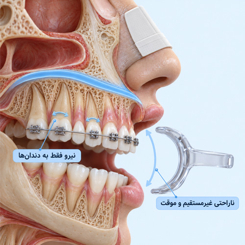 آیا براکت ارتودنسی بعد از عمل بینی به بینی فشار وارد می‌کند؟