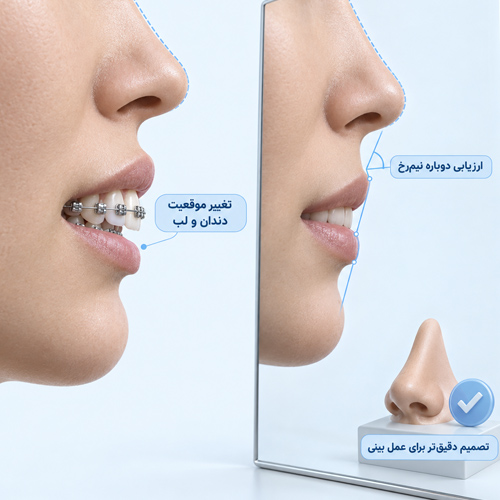 آیا نتیجه ارتودنسی می‌تواند روی تصمیم برای