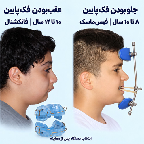 ارتودنسی متحرک برای عقب یا جلو بودن فک در کودکان