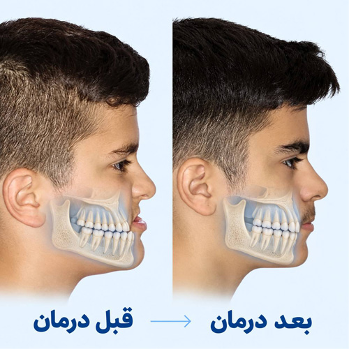 ارتودنسی متحرک برای کودکان