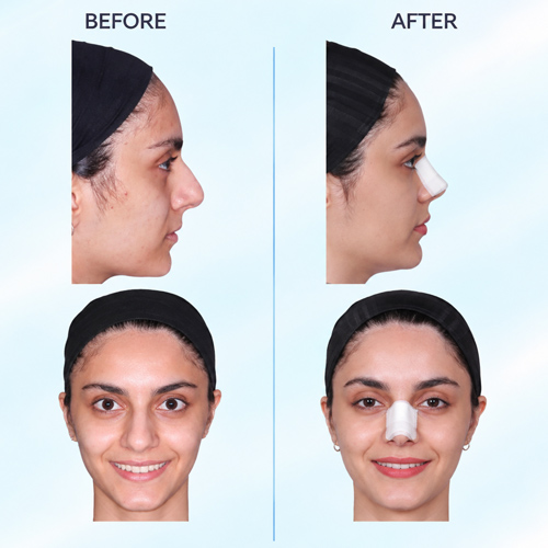 ارتودنسی و عمل بینی