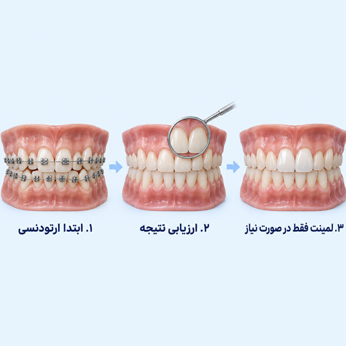 اول ارتودنسی یا لمینت؟