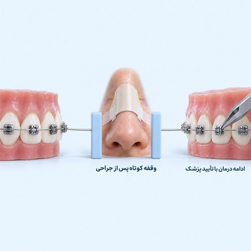 اگر قبل از عمل بینی براکت داشته باشیم، چه زمانی می‌توان ارتودنسی را ادامه داد؟