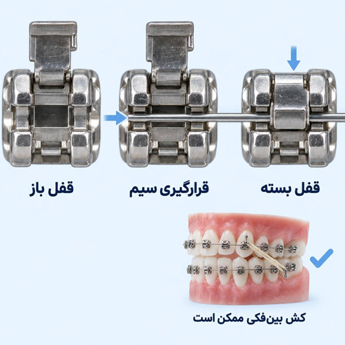 براکت دیمون چگونه سیم ارتودنسی را بدون کش نگه می‌دارد؟