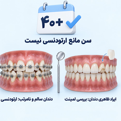 برای بزرگسالان ارتودنسی بهتر است یا لمینت؟