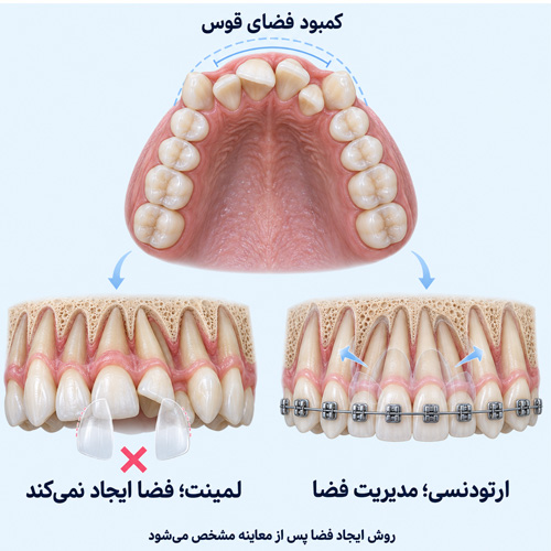 برای دندان‌های شلوغ و روی‌هم‌افتاده ارتودنسی بهتر است یا لمینت؟
