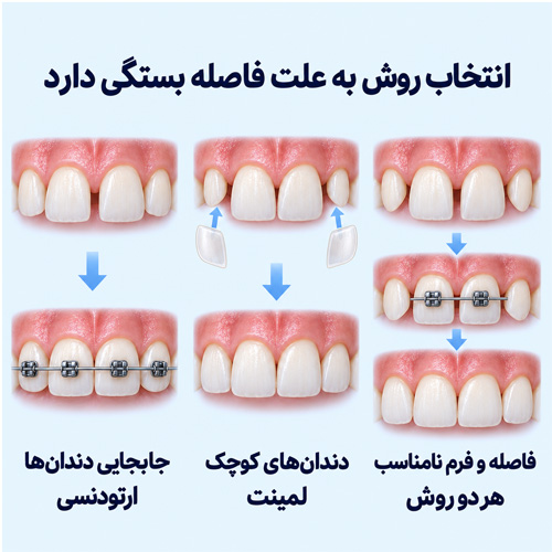 برای فاصله بین دندان‌ها ارتودنسی بهتر است یا لمینت؟