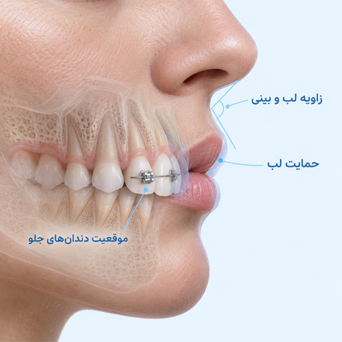 تأثیر ارتودنسی بر فرم لب و زاویه لب و بینی چیست؟