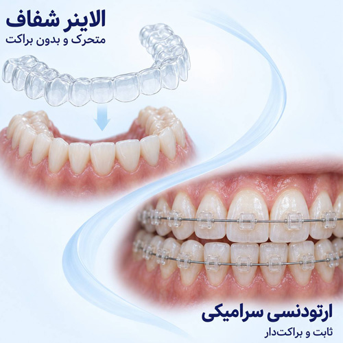 تفاوت ارتودنسی سرامیکی و ارتودنسی نامرئی