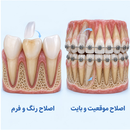 تفاوت ارتودنسی و لمینت چیست؟