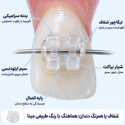 جنس براکت سرامیکی