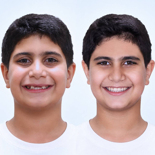 جه زمانی کودک به ارتودنسی نیاز دارد ؟
