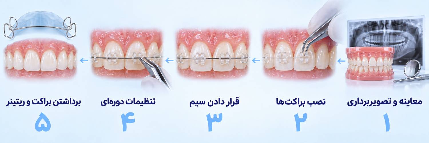 مراحل انجام ارتودنسی سرامیکی