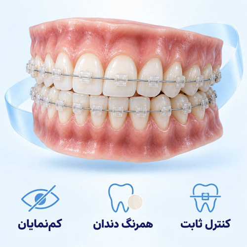مزایای ارتودنسی سرامیکی