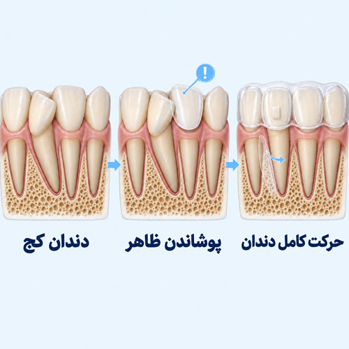 چرا پوشاندن دندان کج با لمینت همیشه جای حرکت دادن دندان را نمی‌گیرد؟